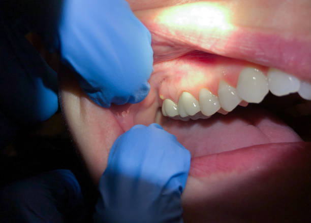 Emergency Dental Filling Replacement in IL